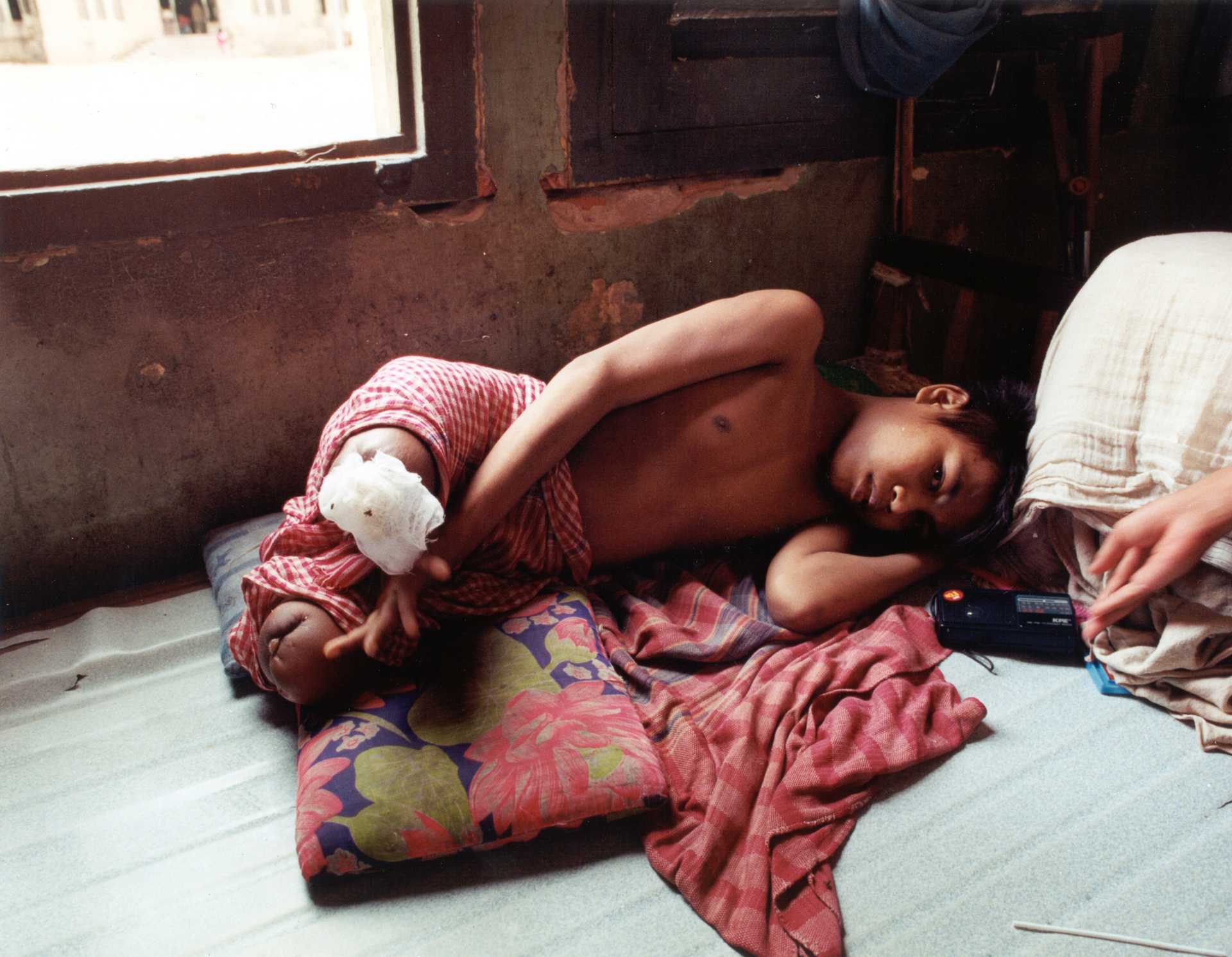 Photograph showing a young person lying on a bed inside a modest room, with a bandaged leg that has been amputated below the knee.